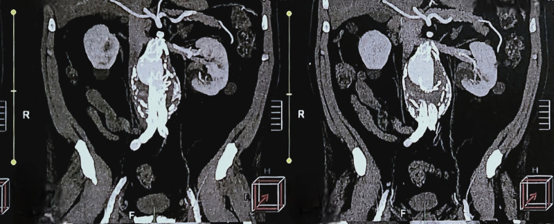 Treatment of type IIIa endoleak and 7-year follow-up: case report.