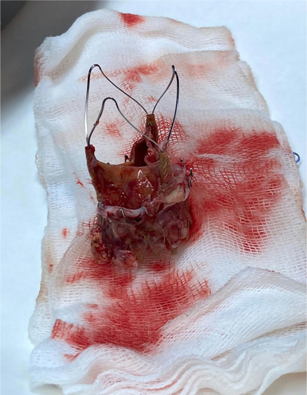 Surgical approach to complicated transcatheter aortic valve implantation endocarditis.