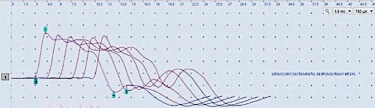 Juvenile Myasthenia Gravis Simulating Bell's Palsy in a 3-year-old Female - A Unique Clinical Presentation.
