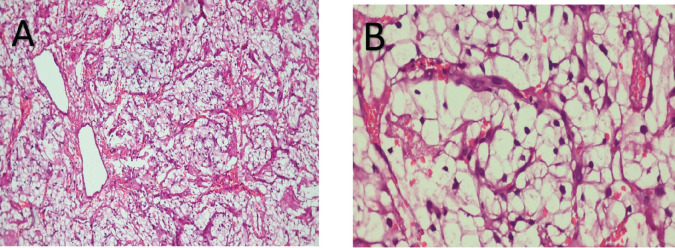 Oral metastasis as initial presentation of renal cell carcinoma: a case report with review of literature.