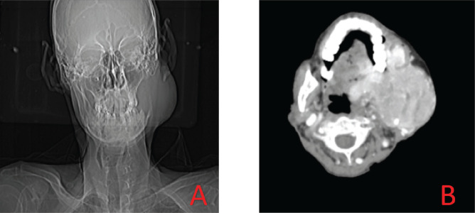 Oral metastasis as initial presentation of renal cell carcinoma: a case report with review of literature.