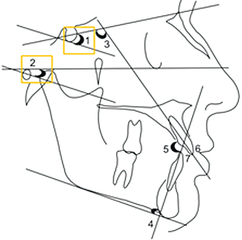The Effect of Mouth Breathing on Facial Anthropometry.