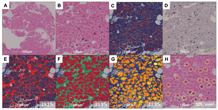 Feasibility and Safety of Atrial Biopsy　- Evidence From 1,000 Cases.