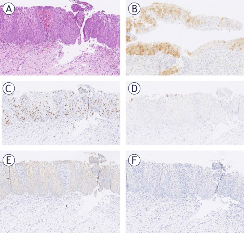 Human papillomavirus (HPV) genotyping and prognostic value of HPV E4 protein and transcription factors NANOG and SOX11 in atypical p16 patchy squamous epithelium of cervix.