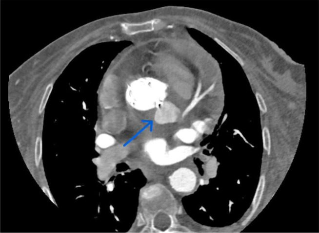 Surgical approach to complicated transcatheter aortic valve implantation endocarditis.