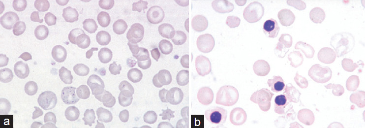Challenges Associated with the Identification of Abnormal Hemoglobin Variants Utilizing the High-performance Liquid Chromatograph Technique: A Prospective Study in a Hospital Setting in Gujarat.