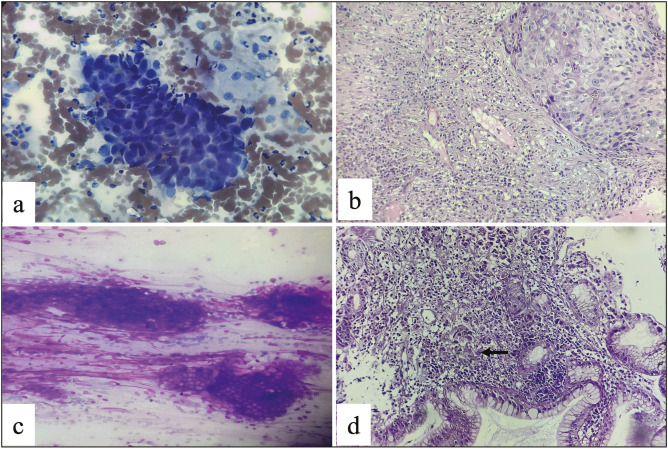 A Comparative Study of Touch Imprint and Crush Cytology with Histopathology in Upper Gastrointestinal Endoscopic Biopsies.