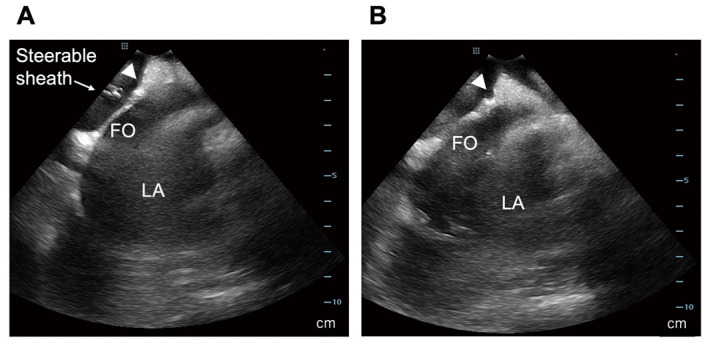 Feasibility and Safety of Atrial Biopsy　- Evidence From 1,000 Cases.