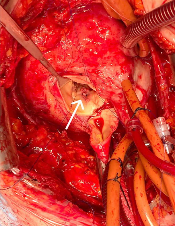 Surgical approach to complicated transcatheter aortic valve implantation endocarditis.