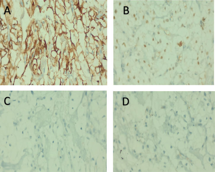 Oral metastasis as initial presentation of renal cell carcinoma: a case report with review of literature.