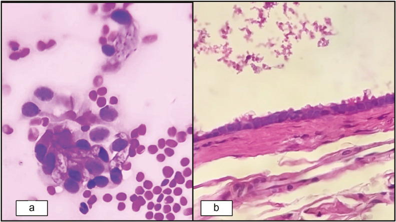 Lingual Foregut Duplication Cyst: A Cytologist's Viewpoint.
