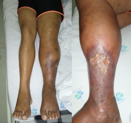 Therapeutic challenge in traumatic arteriovenous fistula of the left lower limb requiring open repair.