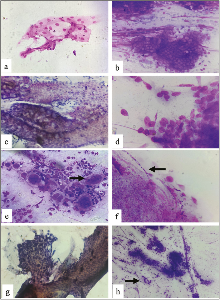 A Comparative Study of Touch Imprint and Crush Cytology with Histopathology in Upper Gastrointestinal Endoscopic Biopsies.