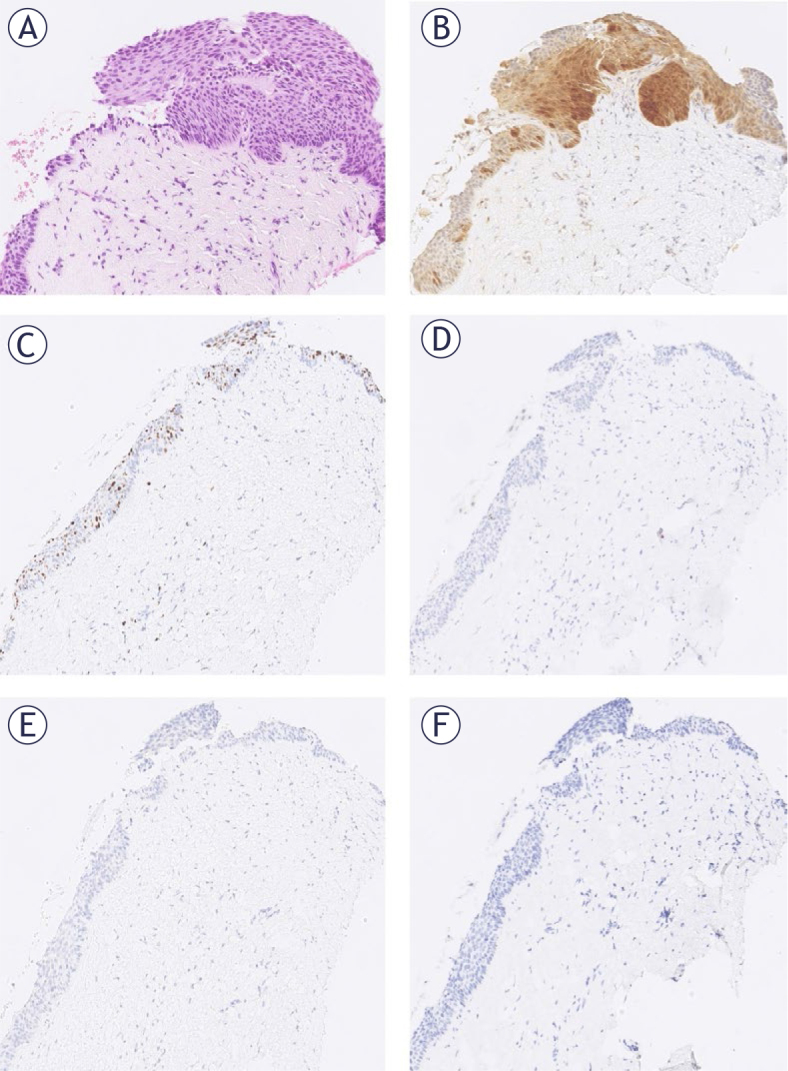 Human papillomavirus (HPV) genotyping and prognostic value of HPV E4 protein and transcription factors NANOG and SOX11 in atypical p16 patchy squamous epithelium of cervix.