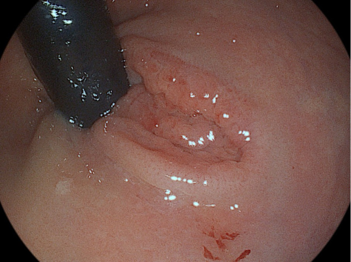 Ectopic Gastric Mucosa in the Rectum: An Underrecognized Cause of Rectal Bleeding.