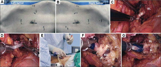 Efficacy and safety of modified laparoscopic single-position radical nephroureterectomy with bladder cuff resection for upper urinary tract urothelial carcinoma: A single-center retrospective study.