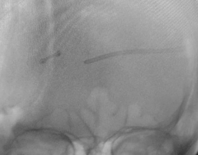 Use of Intraoperative Fluoroscopy for Brain Ventricular Catheter Insertion: Poor Man's Navigation.