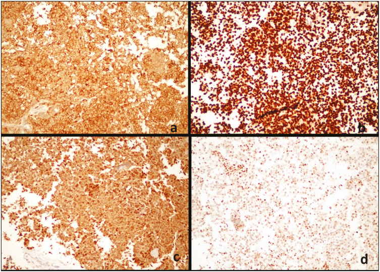 A Rare Melanoma Variant: Small Cell Malignant Melanoma Metastasis in the Lymph Node.