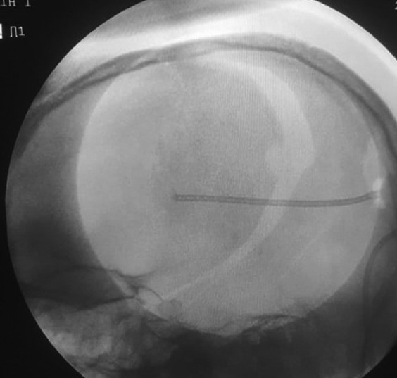 Use of Intraoperative Fluoroscopy for Brain Ventricular Catheter Insertion: Poor Man's Navigation.