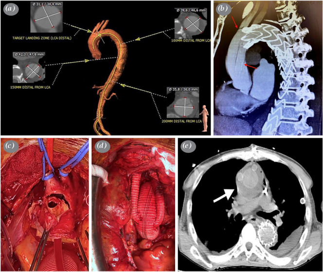 Retrograde aortic dissection after thoracic endovascular aortic repair.
