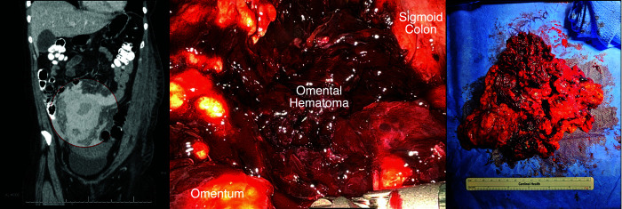 A Trio of Atypical Ectopic Pregnancies.