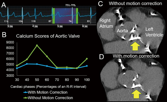 New Generation Motion Correction Algorithm for Accurate Measurement of Aortic Valve Calcium Score.