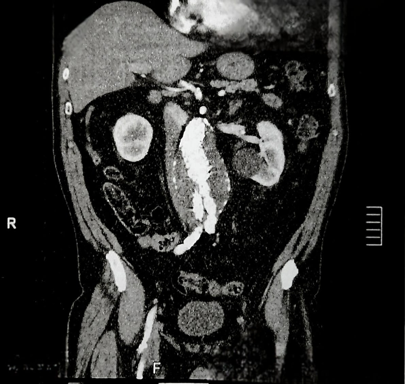 Treatment of type IIIa endoleak and 7-year follow-up: case report.