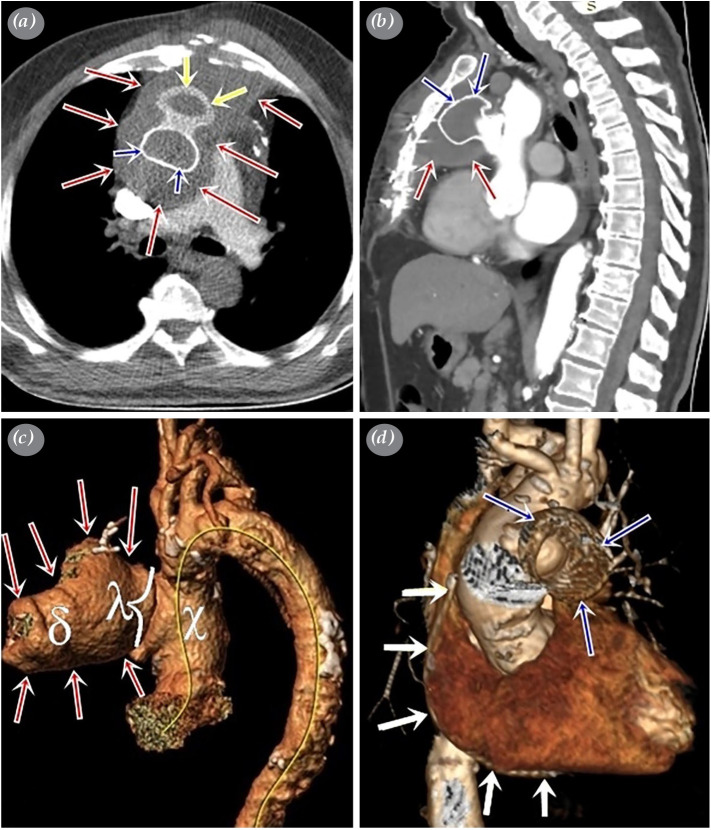 Use of an atrial septal defect occluder for the closure of an ascending aorta pseudoaneurysm after coronary artery bypass grafting.