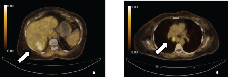 Atezolizumab-induced neuromuscular syndrome mimicking myasthenia gravis in a patient with hepatocellular carcinoma - an area of concern.