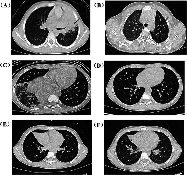 Low-dose versus high-dose methylprednisolone for children with severe <i>Mycoplasma pneumoniae</i> pneumonia (MCMP): A randomized controlled trial.