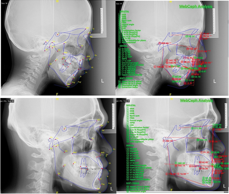 The Effect of Mouth Breathing on Facial Anthropometry.
