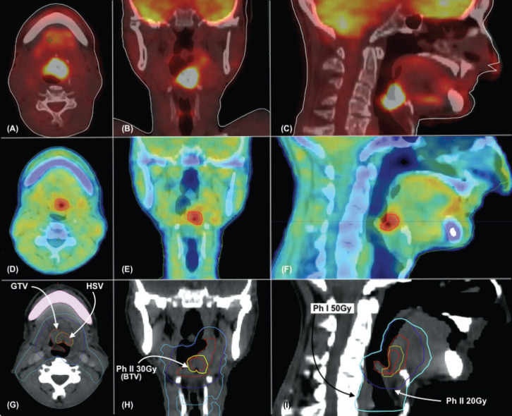 DEHyART trial: Study protocol for phase 2 randomised controlled study assessing the role of dose escalation using [18F] fluoromisonidazole positron emission tomography/computed tomography in head and neck cancers.