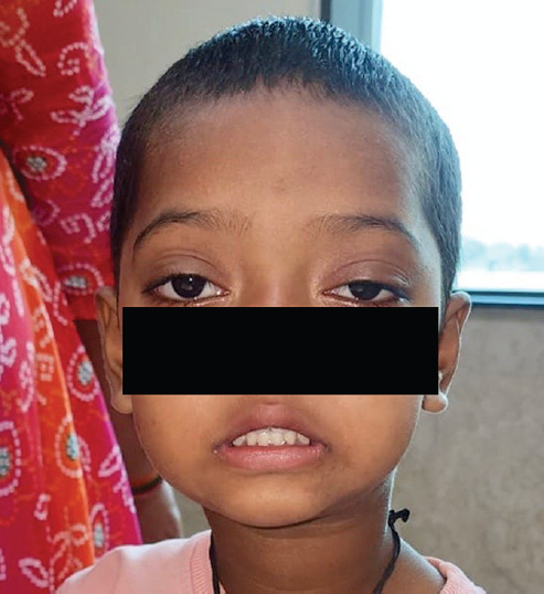Juvenile Myasthenia Gravis Simulating Bell's Palsy in a 3-year-old Female - A Unique Clinical Presentation.