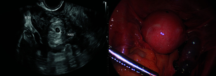 A Trio of Atypical Ectopic Pregnancies.