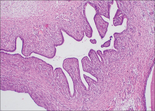 Cervical Adenofibroma: A Rare Cause for Postmenopausal Bleeding.