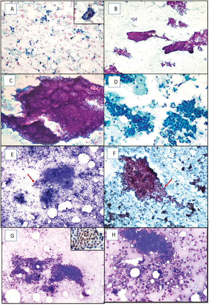 Agreement among Observers with Variable Experience in the Implementation of the Yokohama System for Reporting Breast Fine Needle Aspiration Biopsy Cytopathology.