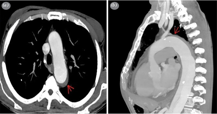 Retrograde aortic dissection after thoracic endovascular aortic repair.