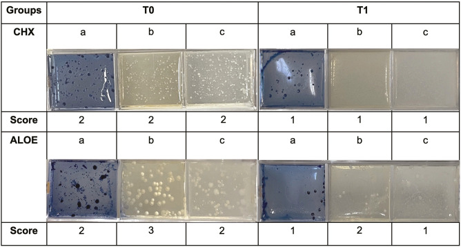 Antimicrobial Effects of Aloe Vera Mouthwash in Adults with Dental Caries: A Preliminary Clinical Trial.