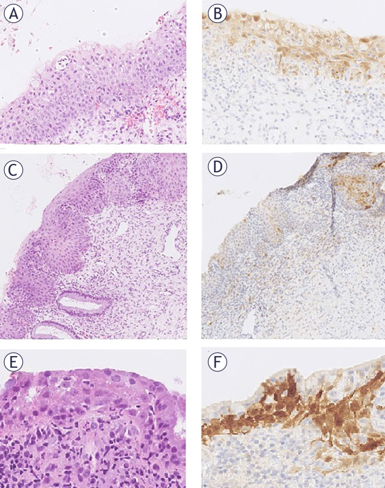Human papillomavirus (HPV) genotyping and prognostic value of HPV E4 protein and transcription factors NANOG and SOX11 in atypical p16 patchy squamous epithelium of cervix.