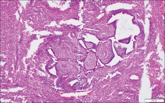 Cervical Adenofibroma: A Rare Cause for Postmenopausal Bleeding.