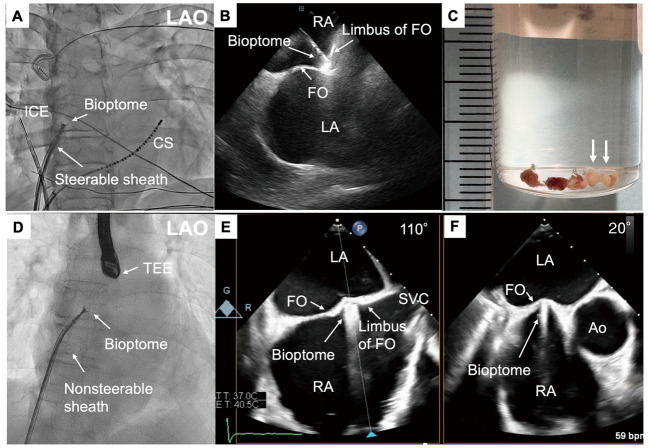 Feasibility and Safety of Atrial Biopsy　- Evidence From 1,000 Cases.