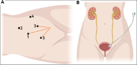Efficacy and safety of modified laparoscopic single-position radical nephroureterectomy with bladder cuff resection for upper urinary tract urothelial carcinoma: A single-center retrospective study.