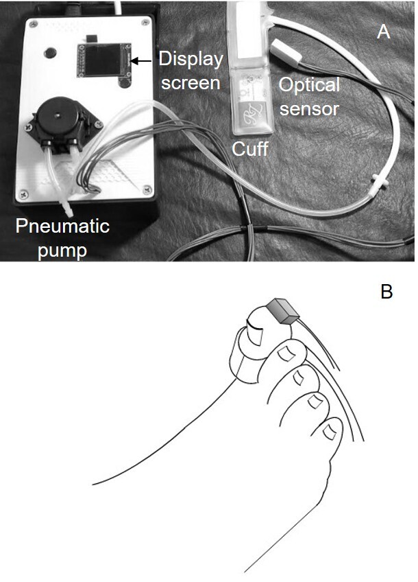 New device for assessing the toe-brachial index and a pilot cross-sectional study in diabetic patients.
