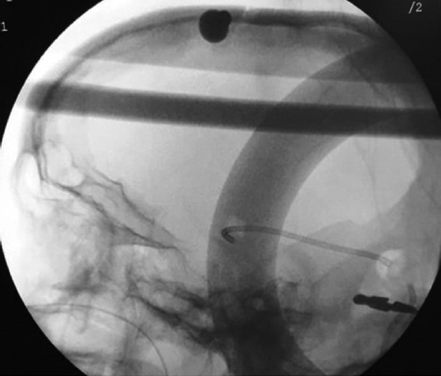 Use of Intraoperative Fluoroscopy for Brain Ventricular Catheter Insertion: Poor Man's Navigation.