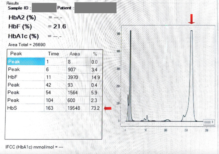 Challenges Associated with the Identification of Abnormal Hemoglobin Variants Utilizing the High-performance Liquid Chromatograph Technique: A Prospective Study in a Hospital Setting in Gujarat.