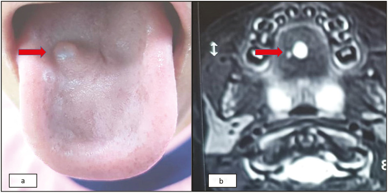 Lingual Foregut Duplication Cyst: A Cytologist's Viewpoint.