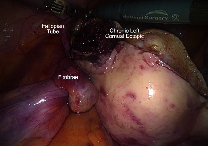 A Trio of Atypical Ectopic Pregnancies.