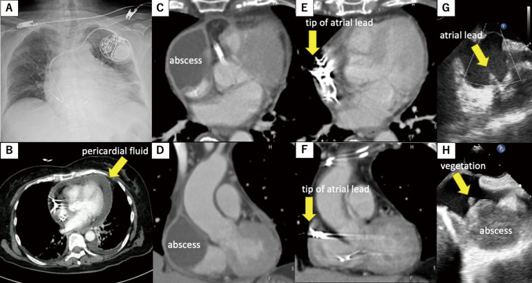 Acute Bacterial Pericarditis 5 Months After Implantation of a DDD Pacemaker.