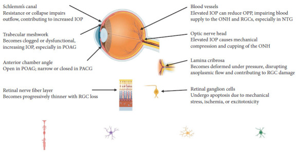 Exploring Glaucoma: From Pathogenesis to Emerging Diagnostic and Management Strategies.