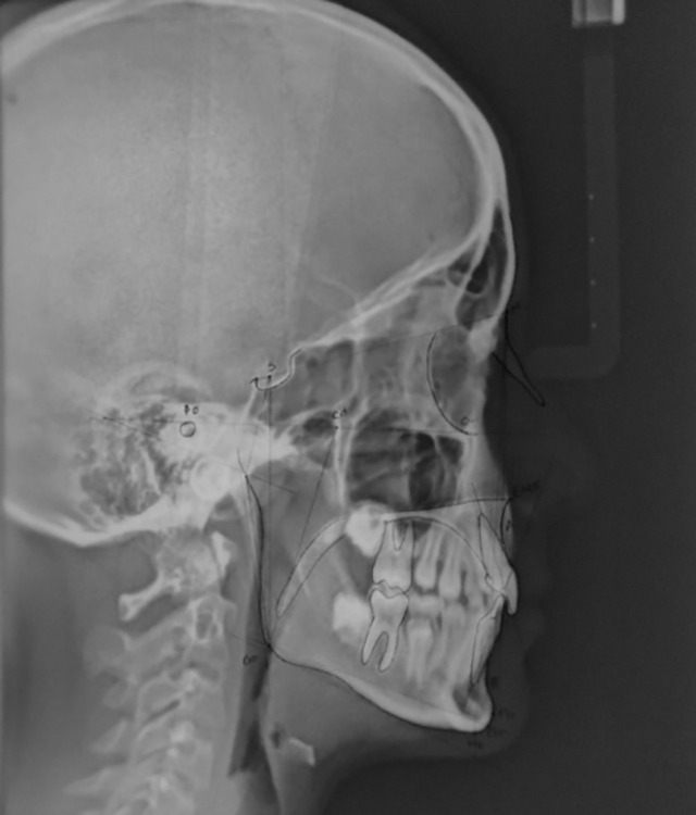 Correlation of Hypertrophic Adenoids and Tonsils with Craniofacial Growth, Occlusion, and Breathing Habit in 4-12-year-old Children.